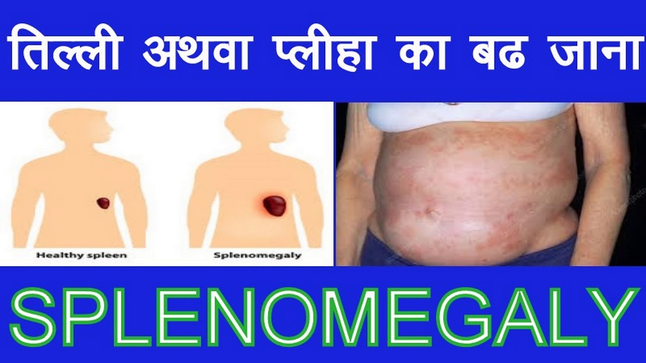 SPLENOMEGALY YouTube SPLENOMEGALY YouTube