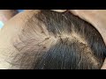 Remove many lice from brown hair  plucking most of lice from head