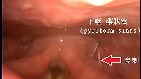 我的住院醫師守則：『看得到的魚刺，就必須夾得出來！』 Fish bone removal at OPD or ER. Dr. Ken-Liao Liu - 天天要聞