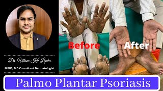 Palmo plantar Psoriasis/causes and treatment of frequent cracks and ulcers on sole?plantar eczema?