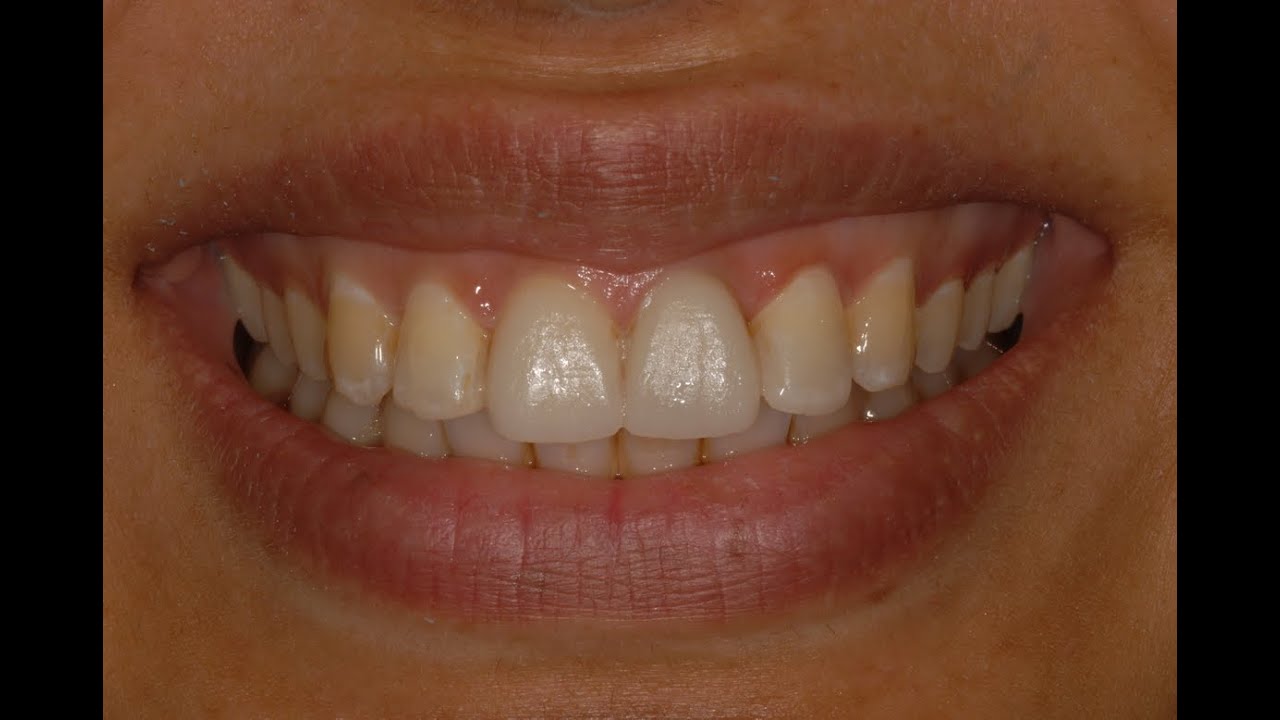 Bisacryl mockup for veneers YouTube