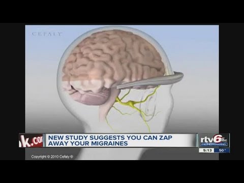 Study finds new device can decrease frequency of migraines without use of drugs
