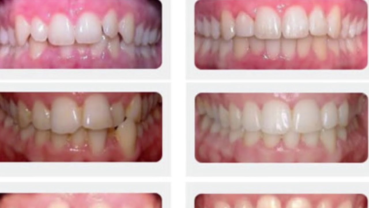 Jefferson dental fast braces video YouTube
