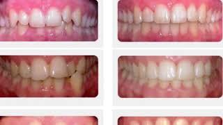 Jefferson dental fast braces video