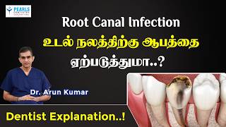 Can a Root Canal Infection Affect Overall Health? | Pearls Dentistry | Chennai