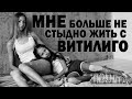 Всё моё тело в пятнах | Avtorka