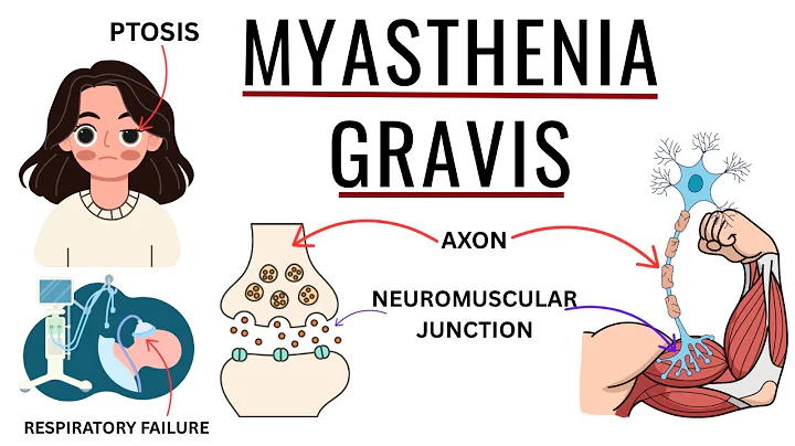 Myasthenia Gravis Clearly Explained - Causes, Symptoms, Diagnosis & Life Saving Treatments!