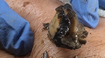 𝑩𝒊𝒈 𝑪𝒚𝒔𝒕𝒊𝒄 𝑨𝒄𝒏𝒆 𝑩𝒍𝒂𝒄𝒌𝒉𝒆𝒂𝒅𝒔 𝑬𝒙𝒕𝒓𝒂𝒄𝒕𝒊𝒐𝒏 & 𝑴𝒊𝒍𝒊𝒂, 𝑾𝒉𝒊𝒕𝒆𝒉𝒆𝒂𝒅𝒔 𝑹𝒆𝒎𝒐𝒗𝒂𝒍 𝑷𝒊𝒎𝒑𝒍𝒆 𝑷𝒐𝒑𝒑𝒊𝒏𝒈 #83404