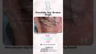 Pencabutan Gigi Geraham Bungsu rahang bawah #odontectomy #cabutgigi #doktergigijakarta