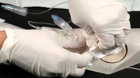 Chapter 8 - PICC Catheter Removal