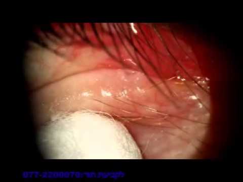 וִידֵאוֹ: דלקת עיניים (Blepharitis) אצל חתולים