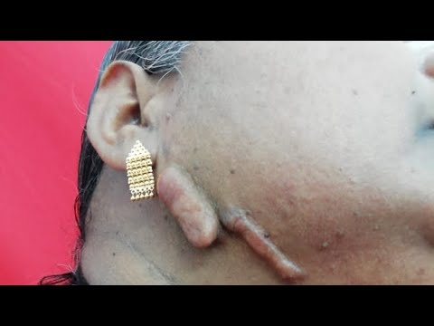 HOW I GOT RID OF MY KELOIDS!(LIVE INJECTIONS PROCEDURE + EARRINGS ) EARLUMS  CLIPS