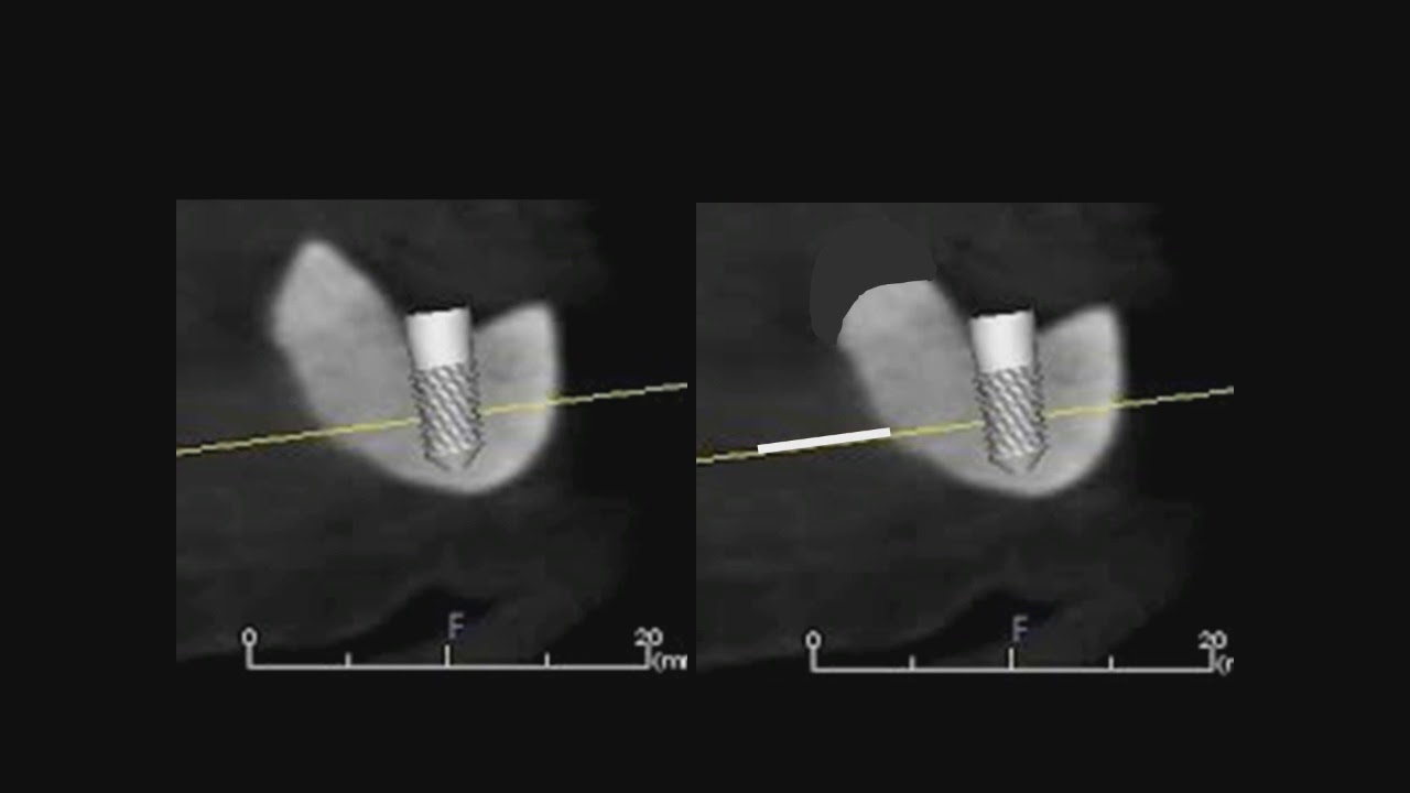 The Use of a Single Implant on a Severely Resorbed Mandibular Ridge ...