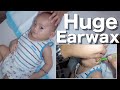 Removing boys huge earwax  its small but terrible