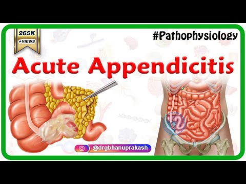 Video: Acute Appendicitis - Symptoms, Treatment, Diagnosis In Children, Complications