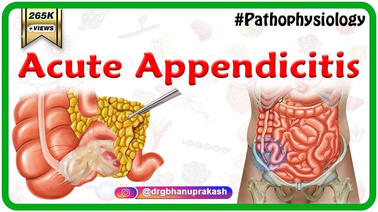 Acute Appendicitis Usmle Step 1 : Etiology, Pathophysiology, Clinical Features, Diagnosis, Treatment