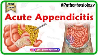 Acute appendicitis USMLE Step 1 : Etiology, Pathophysiology, Clinical Features, Diagnosis, Treatment