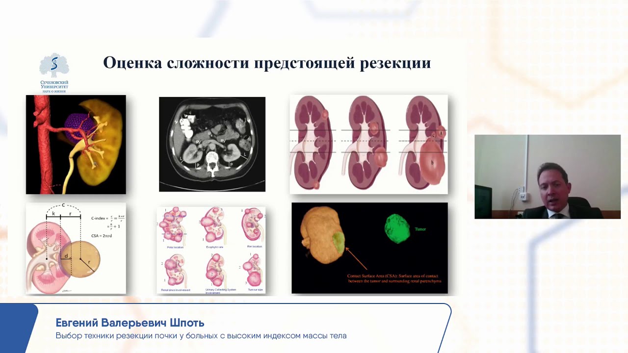 РООУ онкоурология. Тройняшки с онкологией почек. Патология лечения Тимофеев. Рак почки рекомендации