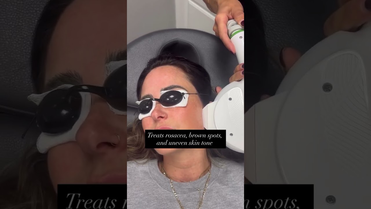 IPL explained! Reduce sun damage, redness, and uneven tone. 