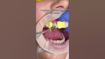 Composite bonding before and after 🦷✨