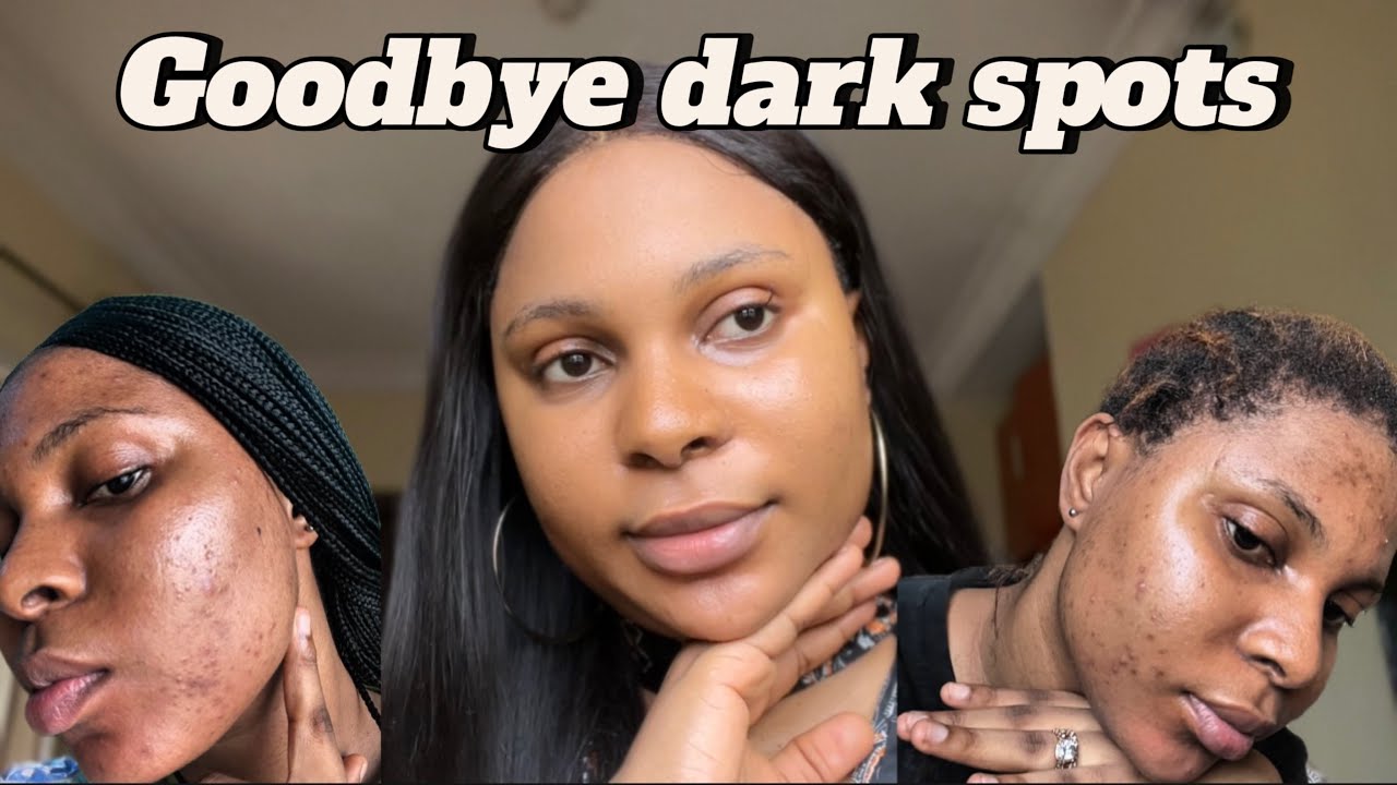 How I faded my dark spots (step by step guide) - YouTube