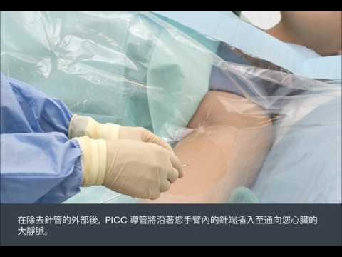Having a Peripherally Inserted Central Catheter - PICC (Chinese) /  裝置週邊插入主靜脈導管（PICC）