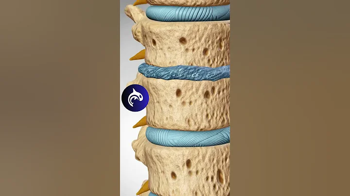 Degenerative Disc Disease - 4K 3D Animation