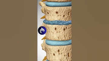 Degenerative Disc Disease - 4K 3D Animation