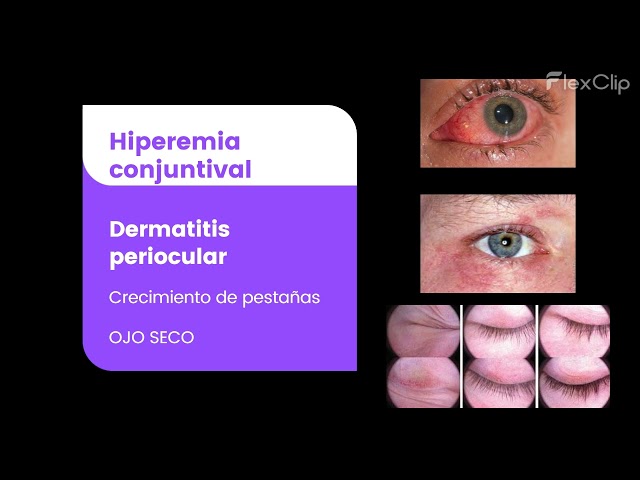 Efectos adversos antiglaucomatosos