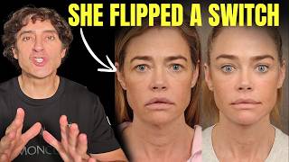 DENISE RICHARDS FACELIFT  Changed Everything