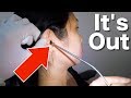 Removing Woman's Hard Impacted Earwax Stuck Deep in Her Ear Canal