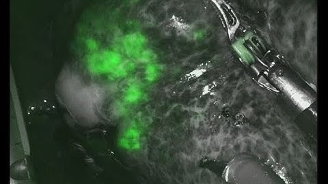 Robotic liver resection with fluorescence