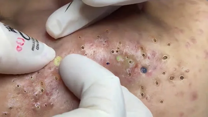 Treat Blackheads And Hidden Acne at Beauty Spa