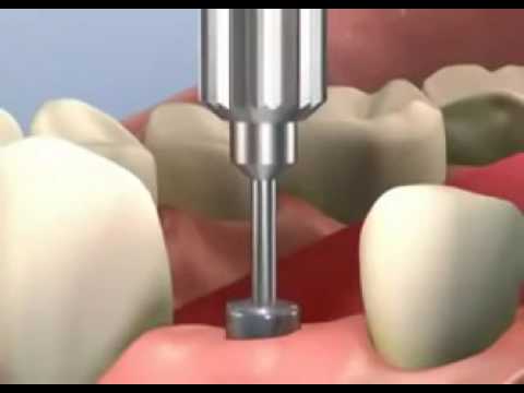 video 1   implante dentario video    veja um vídeo e entenda como é feito implante dentário