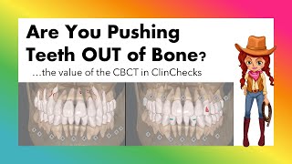 Invisalign ClinCheck and CBCT feature