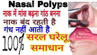 nasal polyps #loss of smell/ heavy breathing#nose blockage #नाक बंद/कारण लक्षण100% सरल घरेलू उपचार