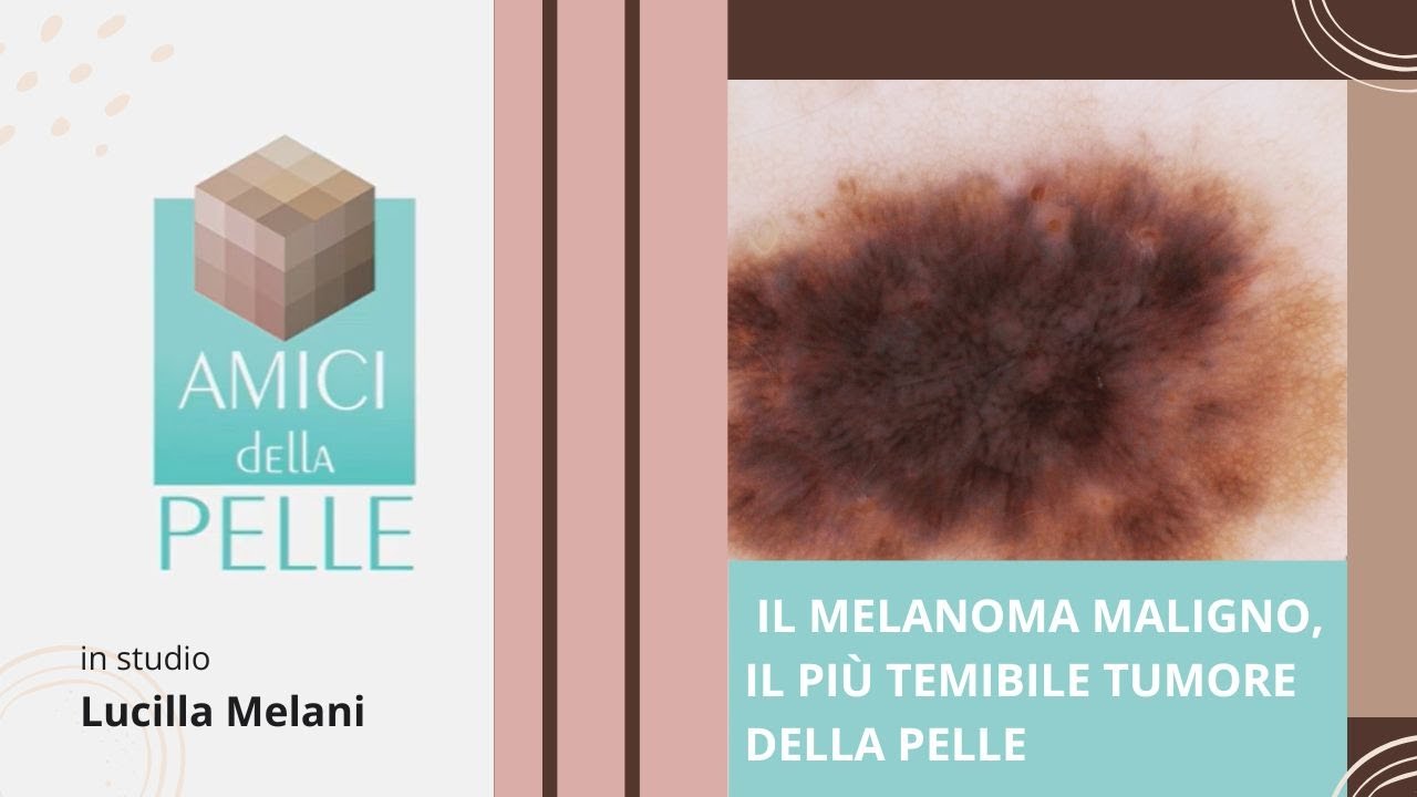 Il melanoma maligno, il più temibile tumore della pelle.