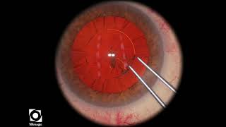Famous EyeSi CAT D Capsulorhexis Errant Tear CW, Medium Tension Wealth
