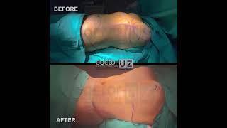 Meme Estetiği Breast Surgery & Karın Germe Tummy Tuck - Before After Op. Dr. Umut Zereyak