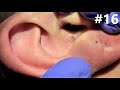 Blackheads extractions on happy 16