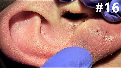 BLACKHEADS EXTRACTIONS on Happy #16