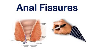 Anal fissures| USMLE Step, NCLEX, COMLEX
