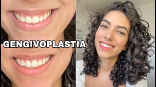 Minha GENGIVOPLASTIA - Dói? Recuperação, antesXdepois | Mayse Cavalcante