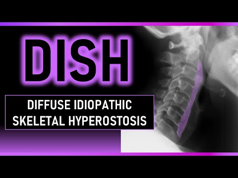 Diffuse Idiopathic Skeletal Hyperostosis - DISH