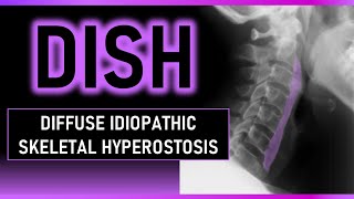 Diffuse Idiopathic Skeletal Hyperostosis #dish #radiology #bones