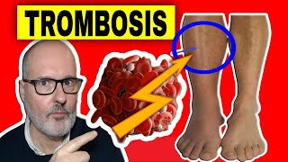 DEEP VENOUS THROMBOSIS in the LEGS: causes, symptoms, prevention and treatment