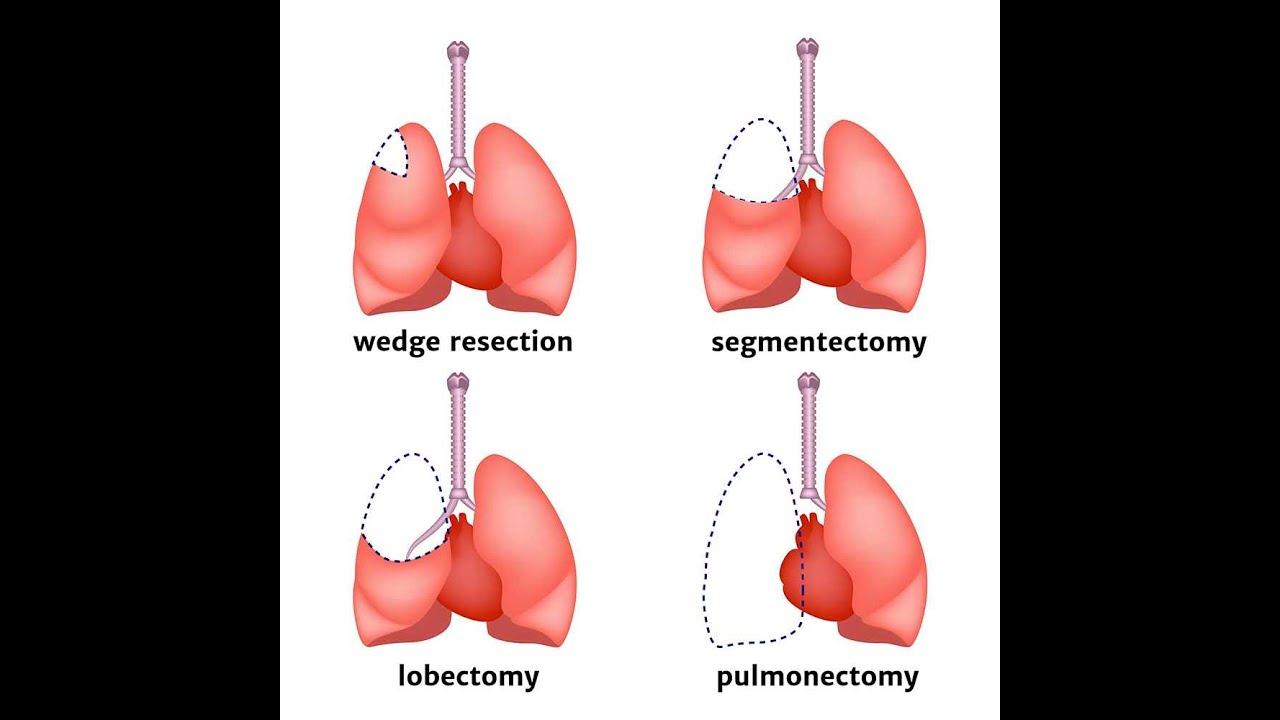 Segmentectomy Surgery ; Definition, Types, Procedure, Benefits, Risks and Recovery