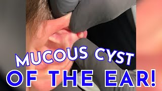 Mucous Cyst Of The Ear