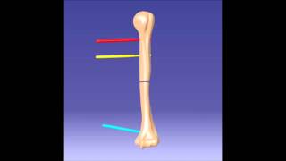 Fixation Animation - Mitkovic External Fixator - Humerus