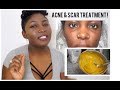 TURMERIC FACE MASK DID THIS IN JUST 7 DAYS! | DIY TREATMENT FOR SCARS AND ACNE (2018)